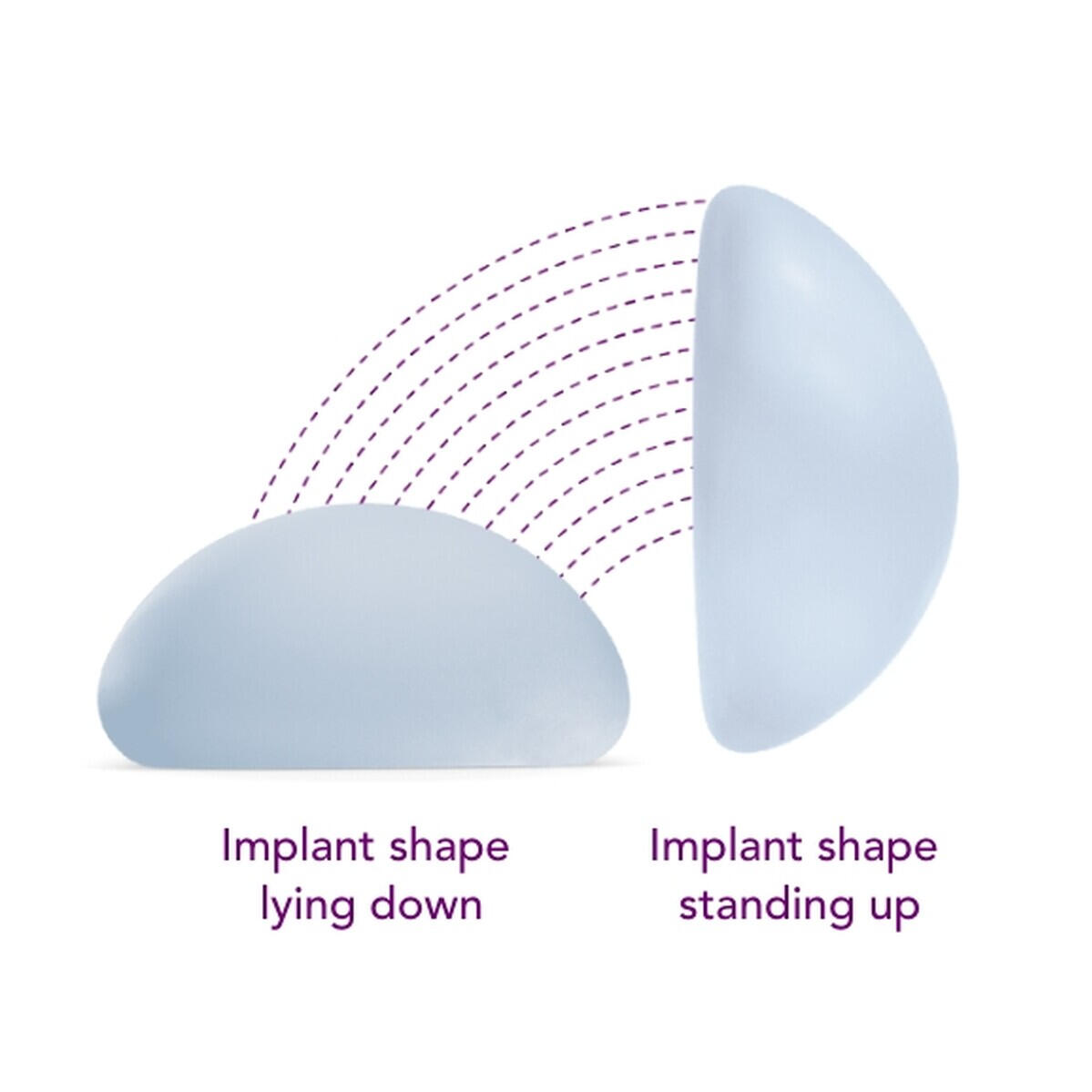 Ergonomix® implants adapt smoothly and naturally